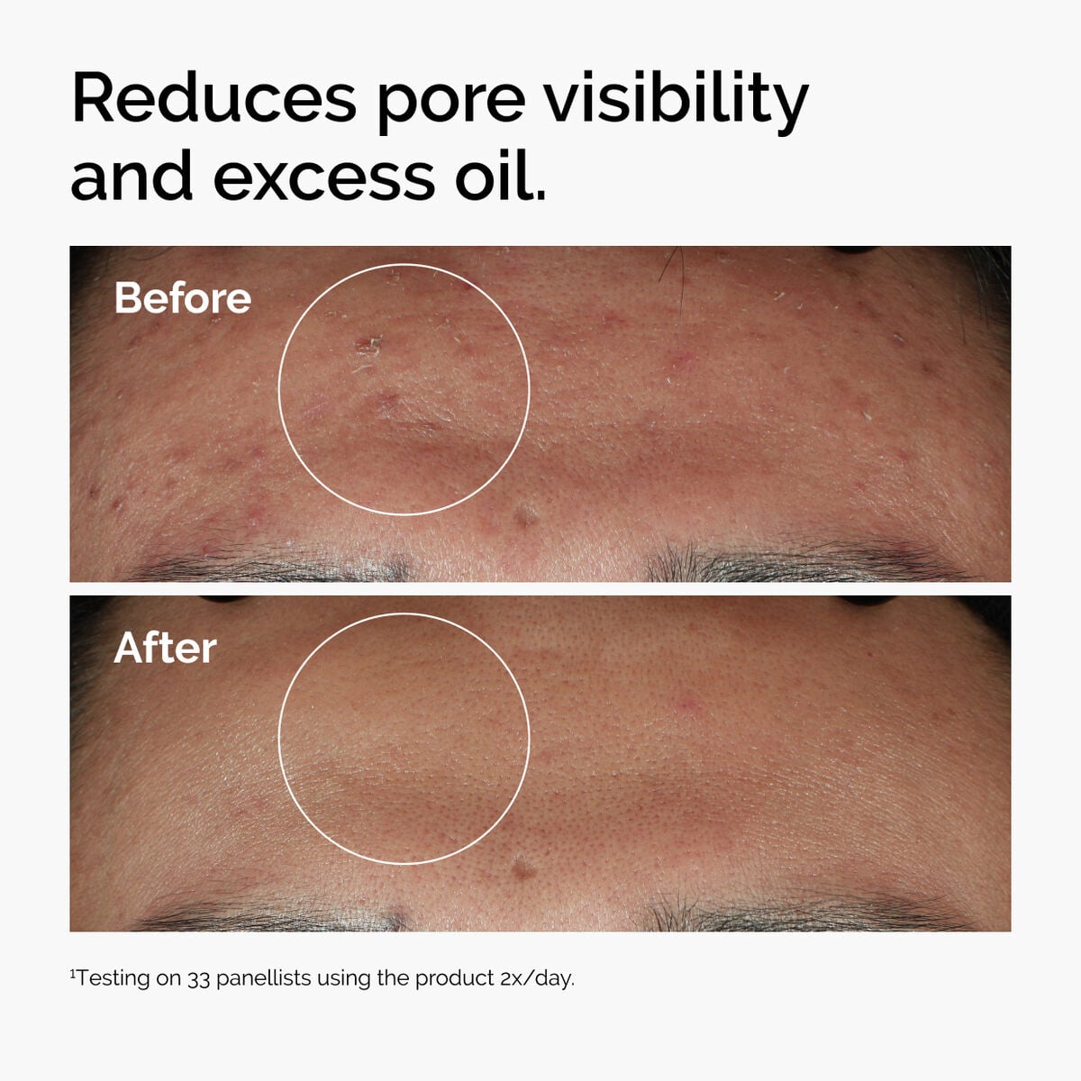 niacinamide-10-zinc-1-z3 ord-niacinamide-zinc-blemish-serum-before-after-pores.jpg
