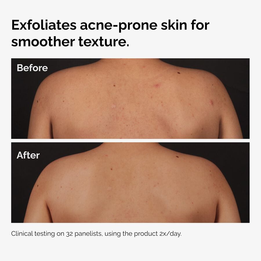 the-body-care-collection-v0 ord-salicylic-acid-body-serum-before-after-graphic-NA.jpg